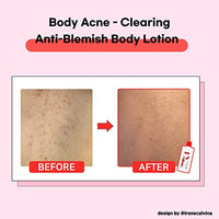 Thumbnail for Image 3 of TIAM Anti-Blemish Body Lotion, 6.76 fl oz