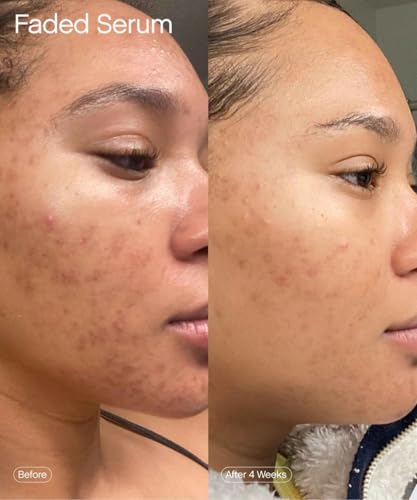 Topicals Faded Brightening and Clearing Serum | Reduces Discoloration, Post-Blemish Marks, Scars and Spots | Contains Kojic Acid and Niacinamide | Dermatologist-tested, Vegan, Cruelty-Free (1.7 Fl Oz)