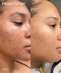 Thumbnail for Topicals Faded Brightening and Clearing Serum | Reduces Discoloration, Post-Blemish Marks, Scars and Spots | Contains Kojic Acid and Niacinamide | Dermatologist-tested, Vegan, Cruelty-Free (1.7 Fl Oz)