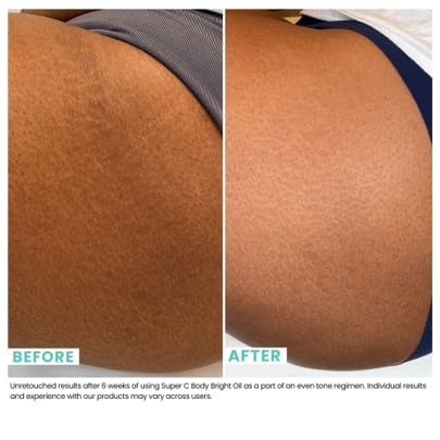 Urban Skin Rx® Pro Strength Super C Hydrating Body Bright Oil, Brightens, Nourishes & Rejuvenates for Smooth, Glowing Skin, Improves Appearance of Scars, Aging, Discoloration & Stretch Marks, 4 Fl Oz
