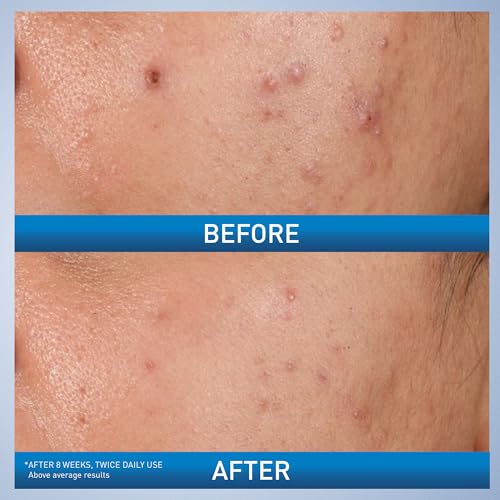 CeraVe Acne Control Gel, 2% Salicylic Acid Treatment With Glycolic Acid + Lactic Acids + Niacniamide, Acne Gel Helps Clear Blemishes Without Over Drying, Alcohol Free & Oil Free, 1.35 Fl Oz