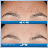 Thumbnail for CeraVe Resurfacing Retinol Serum For Post Acne Marks, Formulated With Licorice Root Extract & Niacinamide, Brightening Serum & Pore Minimizer For Face, Post Acne Skin Barrier Repair, Non-Comedogenic