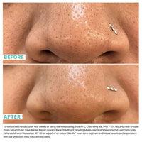 Thumbnail for Urban Skin Rx® PHA + 10% Niacinamide Smaller Pores Serum, Tightens Pores for Clear, Brighter & Smoother Skin, Exfoliates, Decongests, Controls Excess Oil, & Fights Against Future Breakouts, 1 Fl Oz.
