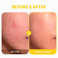 Thumbnail for TIRTIR Pure Vitamin C 24% Face Serum – Dark Spot Remover for Sensitive Skin with Collagen Anti Aging Even out Skin Tone Non irritation tested, Wrkinkles, Korean Mild Vita C Facial Serum 1.01 Fl Oz