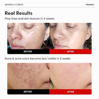 Thumbnail for FRANKLY Retinol 0.1% Cream, 1.01 fl oz - Beginner Retinol | Night Cream | with Ceramides & Natural Ginseng | Anti-aging, Wrinkles Care, Reduces Congestion and hyperpigmentation | Korean Skin Care