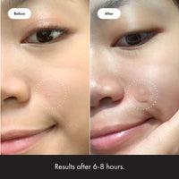 Thumbnail for Mighty Patch™ Original patch from Hero Cosmetics - Hydrocolloid Acne Pimple Patch for Covering Zits and Blemishes in Face and Skin, Vegan-friendly and Not Tested on Animals (36 Count)