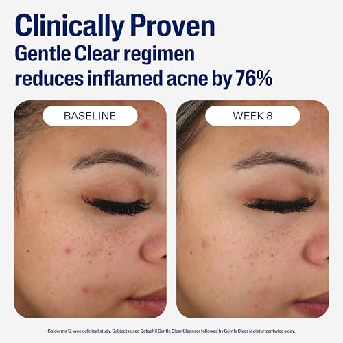 Image 5 of Cetaphil Face Moisturizer, Gentle Clear Mattifying Acne Moisturizer With 0.5% Salicylic Acid, 3oz (Pack of 12)