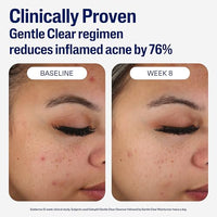 Thumbnail for Image 5 of Cetaphil Face Moisturizer, Gentle Clear Mattifying Acne Moisturizer With 0.5% Salicylic Acid, 3oz (Pack of 12)