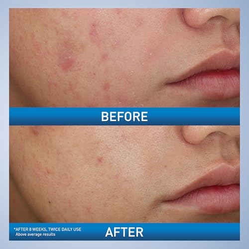 Image 3 of CeraVe Acne Foaming Cream Wash, 10% Benzoyl Peroxide Facial Cleanser, 5oz
