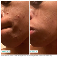 Thumbnail for Urban Skin Rx 2-Pack Clear Skin & Combination Skin Cleansing Bar Duo | Helps Diminish Look of Spots & Blemishes, Removes Excess Oil, 3-in-1 Daily Cleanser, Exfoliant & Mask Includes (2) 2.0 Oz Bars