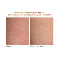 Thumbnail for Dr Dennis Gross Alpha Beta Exfoliating Body Treatment | Multi-Tasking Powered by AHA/BHAs for Smooth, Hydrated Skin While Improving Ingrown Hairs, Keratosis Pilaris, and Blemishes | 8 Textured Towels