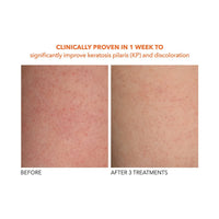 Thumbnail for Dr. Dennis Gross Alpha Beta Exfoliating Body Treatment | Multi-Tasking Powered by AHA/BHAs for Smooth, Hydrated Skin While Improving Ingrown Hairs, Keratosis Pilaris, and Blemishes | 2 Textured Towels