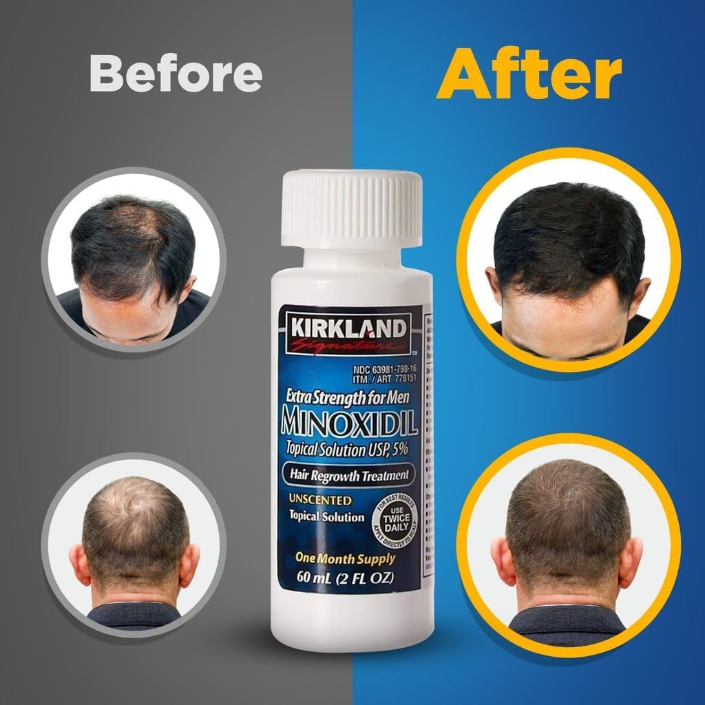 Minoxidil for Men 5% Extra Strength Hair Regrowth for Men fLsbok, 6 Month Supply by Kirkland Signature, 6 Pack (2 oz Bottle)