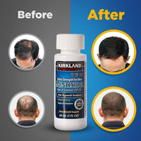 Thumbnail for Minoxidil for Men 5% Extra Strength Hair Regrowth for Men fLsbok, 6 Month Supply by Kirkland Signature, 6 Pack (2 oz Bottle)