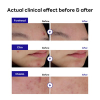 Thumbnail for Mediheal Derma Clear Madecassoside Blemish Spot Patch (44 Counts) - Acne Spot Protection, Spot Fast Healing with Madecassoside & Niacinamide