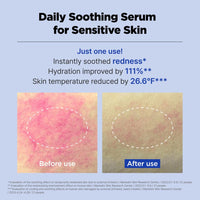 Thumbnail for ACNI Dr. 1st Control Serum, Fast-Soothing Formula for Acne-Prone Skin, Non-Comedogenic Daily Serum for Oil-Water Balance, Korean Skin Care (1.35 fl.oz./40ml)