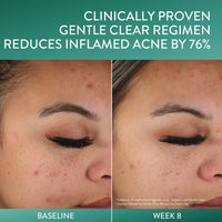 Thumbnail for Cetaphil Acne Clearing Kit - Clarifying Acne Cream Cleanser (4.2 oz) & Mattifying Acne Moisturizer (3 oz) with Salicylic Acid, Deep Clean, Hydrate and Treat Sensitive Acne Prone Skin