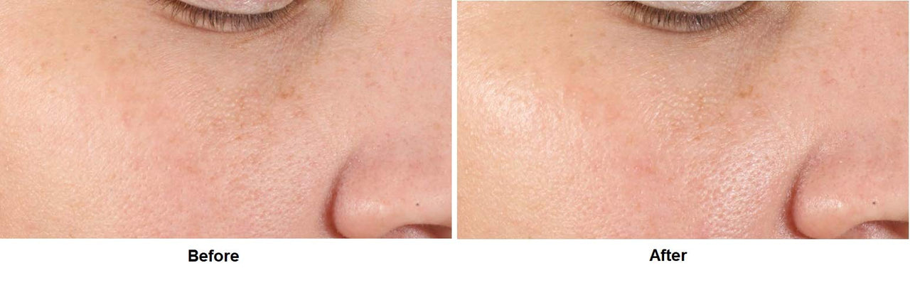 Dr. Dennis Gross Alpha Beta® Pore Perfecting & Refining Serum: for Enlarged, Clogged Pores with Excessive Oil, 1.0 fl oz