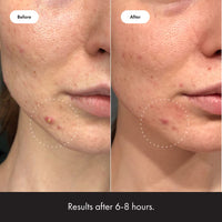 Thumbnail for Mighty Patch™ Invisible+ Patch - Daytime Hydrocolloid Acne Pimple Patches for Covering Zits and Blemishes, Ultra Thin Spot Stickers for Face and Skin (24 Medium and 15 Small Patches)