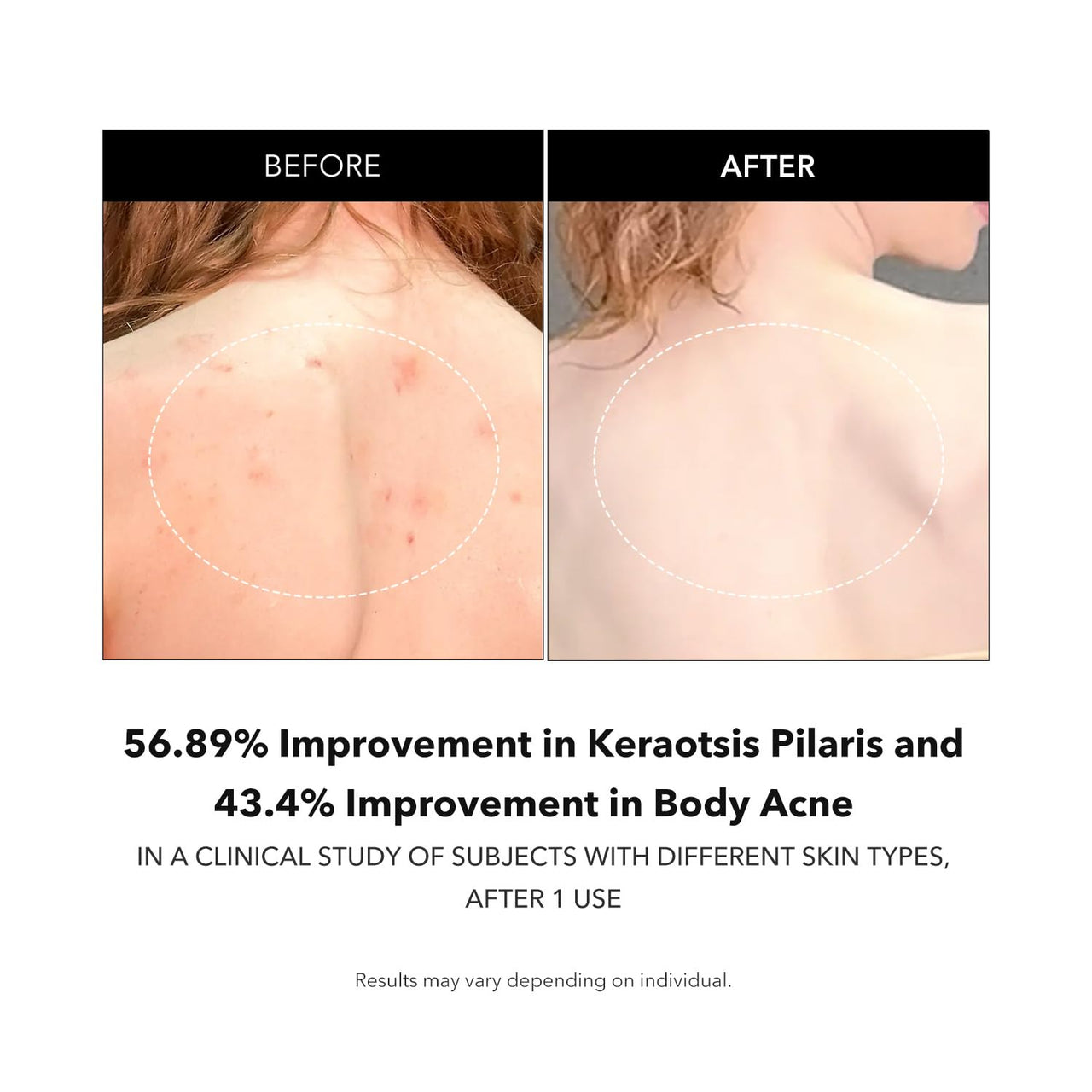 APRILSKIN Carrotene IPMP™ Exfoliating Body Wash | Salicylic Acid Body Wash Improve Rough & Bumpy Skin, Body Acne, Keratosis Pilaris with Niacinamide & Ceramides | Vegan & Cruelty-free | 10.14 fl.oz