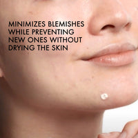 Thumbnail for Vichy Normaderm S.O.S Acne Rescue Spot Corrector, Acne Spot Treatment for Face with 10% Sulfur, Niacinamide & Glycolic Acid, Suitable for Sensitive Skin