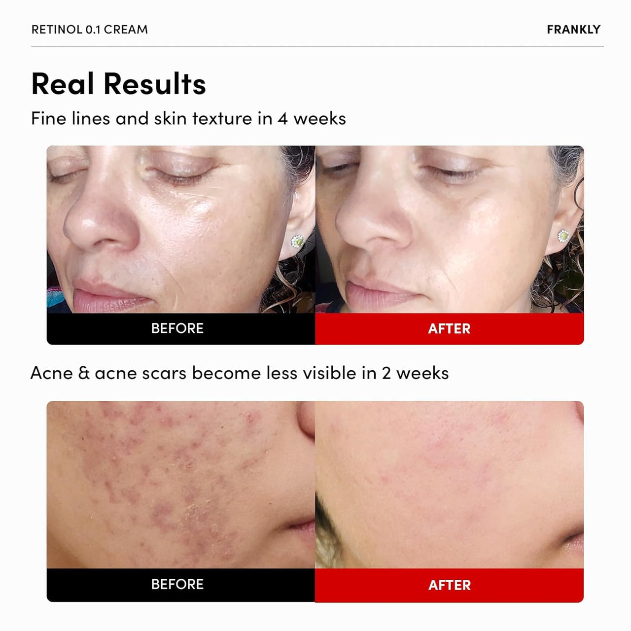 FRANKLY Retinol 0.3% Cream, 0.7 fl oz - Korean Intensive Retinol | Night Cream | Ceramides & Natural Ginseng | Anti-aging, Wrinkles Care, Reduces Congestion and hyperpigmentation | Korean Skin Care