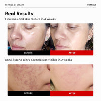 Thumbnail for FRANKLY Retinol 0.3% Cream, 0.7 fl oz - Korean Intensive Retinol | Night Cream | Ceramides & Natural Ginseng | Anti-aging, Wrinkles Care, Reduces Congestion and hyperpigmentation | Korean Skin Care