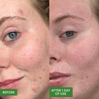 Thumbnail for Sand & Sky Pimple Patches for Face Hydrocolloid Acne Patches with Salicylic Acid & Tea Tree Oil - Blemish Spot Patches for Whiteheads, 75 Patches