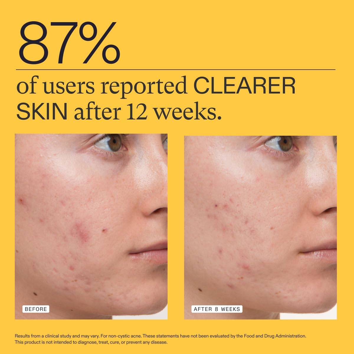 Nutrafol Clear Skin Acne Supplement for Women, Clinically Tested for Clearer, Smoother Skin, Physician-Formulated, Vegan - 3-Month Supply, Pack of 3
