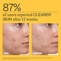 Thumbnail for Nutrafol Clear Skin Acne Supplement for Women, Clinically Tested for Clearer, Smoother Skin, Physician-Formulated, Vegan - 3-Month Supply, Pack of 3