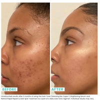 Thumbnail for Urban Skin Rx® Even Tone Cleansing Bar | 3-in-1 Multitasking Treatment Daily Cleanser, Exfoliator, & Mask | Targets Uneven Skin & Improves the Appearance of Dark Spots | Includes Applicator | 2.0 Oz