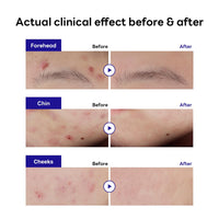 Thumbnail for Mediheal Derma Clear Teatree Treatment Spot Patch (44 Counts) - Acne Relief, Oil and Moisture Balance with Teatree & Salicylic Acid