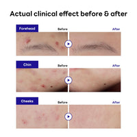 Thumbnail for Mediheal Derma Clear Teatree Treatment Spot Patch (44 Counts) - Acne Relief, Oil and Moisture Balance with Teatree & Salicylic Acid