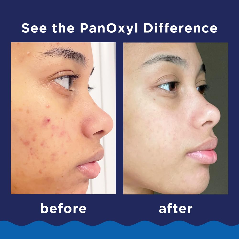 PanOxyl 10% Benzoyl Peroxide Acne Foaming Wash, Maximum Strength, Daily Acne-Fighting Face & Body Cleanser, Face Wash to Clear, Treat and Prevent Acne Pimples and Stubborn Breakouts, 5.5 Oz, Pack of 2