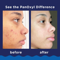 Thumbnail for PanOxyl 10% Benzoyl Peroxide Acne Foaming Wash, Maximum Strength, Daily Acne-Fighting Face & Body Cleanser, Face Wash to Clear, Treat and Prevent Acne Pimples and Stubborn Breakouts, 5.5 Oz, Pack of 2