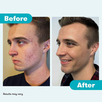 Thumbnail for Proactiv Acne Cleanser - Benzoyl Peroxide Face Wash and Acne Treatment - Daily Facial Cleanser and Hyularonic Acid Moisturizer with Exfoliating Beads - 90 Day Supply, 6 Fl Oz