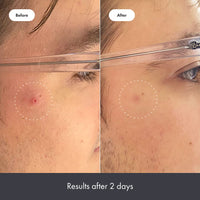 Thumbnail for Hero Cosmetics Rescue Balm Post-Blemish Recovery Cream - Intensive Nourishing and Calming for Dry, Red-Looking Skin After a Blemish - Dermatologist Tested (50 ml, 1.69 fl. oz)