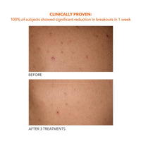 Thumbnail for Dr. Dennis Gross Alpha Beta Exfoliating Body Treatment | Multi-Tasking Powered by AHA/BHAs for Smooth, Hydrated Skin While Improving Ingrown Hairs, Keratosis Pilaris, and Blemishes | 2 Textured Towels