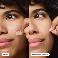 Thumbnail for Mighty Patch™ Invisible+ Patch – The Barely-There Daytime Hydrocolloid Acne Pimple Patch for Covering Zits and Blemishes, Tapered Edges Designed to Blend Into Skin (72ct)