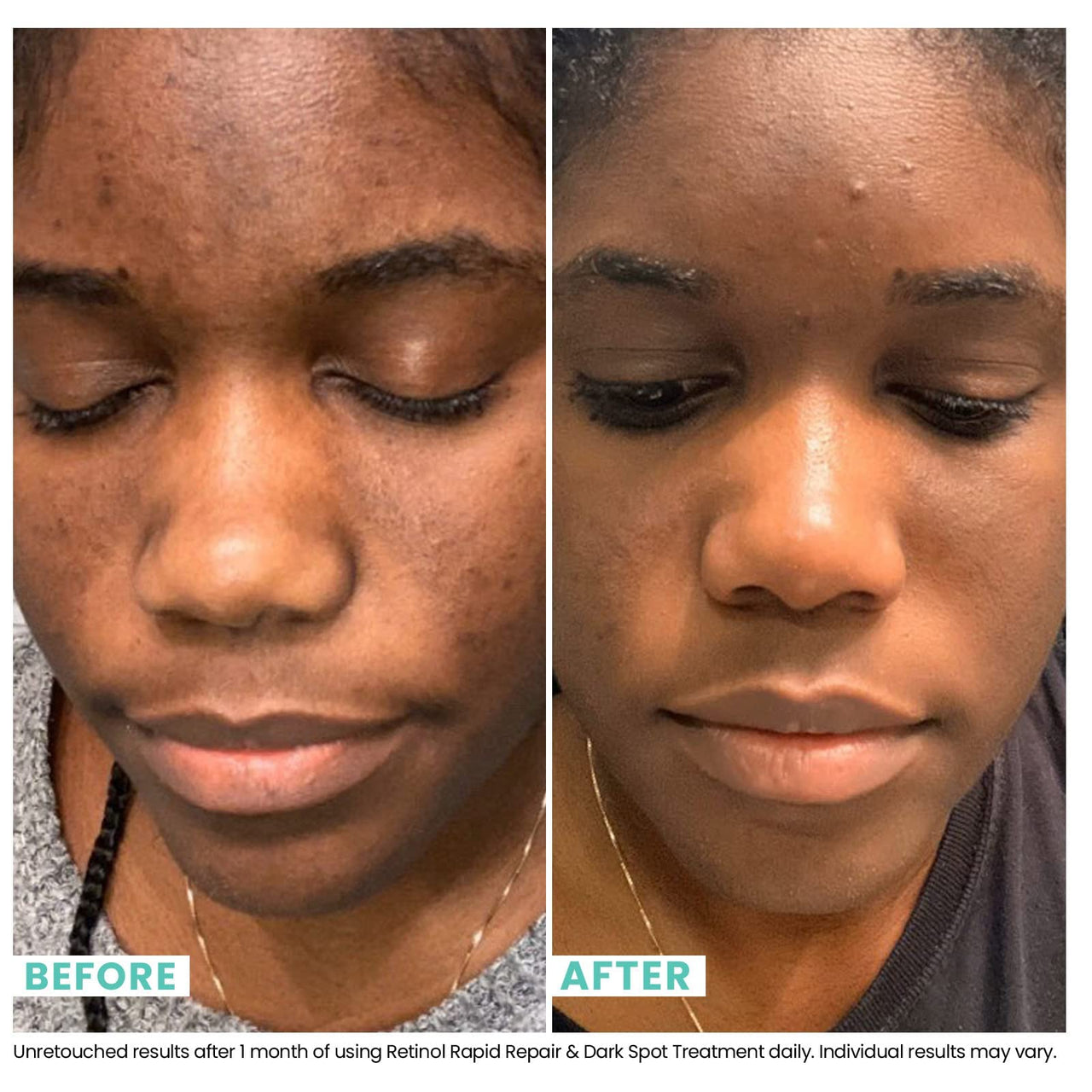 Urban Skin Rx® Retinol Rapid Repair + Dark Spot Treatment Facial Serum, Targets Fine Lines, Hyperpigmentation & Blemishes, Improves Appearance of Tone, Scarring, Fine Lines & Enlarged Pores,1 Fl Oz