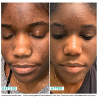 Thumbnail for Urban Skin Rx® Retinol Rapid Repair + Dark Spot Treatment Facial Serum, Targets Fine Lines, Hyperpigmentation & Blemishes, Improves Appearance of Tone, Scarring, Fine Lines & Enlarged Pores,1 Fl Oz