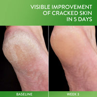 Thumbnail for Cetaphil Cracked Skin Repair Balm, 3 oz, For Very Rough & Cracked, Sensitive Skin, Protects, Soothes & Restores Deeper Cracks, Hypoallergenic, Fragrance Free, (Packaging May Vary)