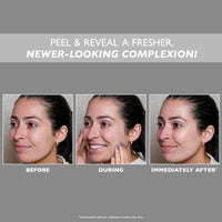 Thumbnail for Peter Thomas Roth | FIRMx® Peeling Gel, Travel Size | Exfoliant for Dry and Flaky Skin, Enzymes and Cellulose Help Remove Impurities and Unclog Pores, 1 fl. oz