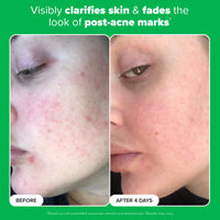 Thumbnail for Paula's Choice BOOST 10% Azelaic Acid Booster Cream Gel, Licorice Extract & Salicylic Acid, Oil-Free Skin Brightening Serum, 1 Ounce