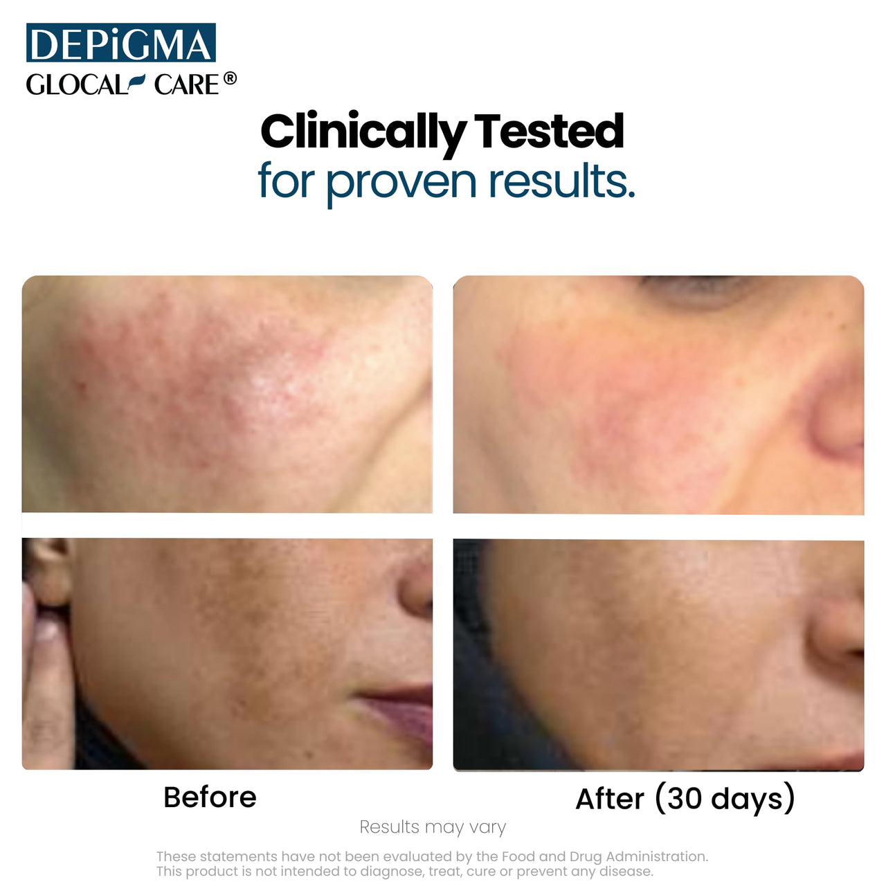 GlocalCare Depigma Support Reduction of Hyperpigmentation, Melasma & Dark Spots with Glutathione, Polypodium Leucotomos, Grape Seed & Marigold Extract