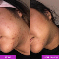 Thumbnail for Good Molecules Discoloration Correcting Serum - Tranexamic Acid Ester Salt and Niacinamide for Dark Spots, Sun Damage, and Age Spots - Skincare Face