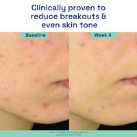 Thumbnail for Cetaphil Gentle Clear Triple-Action Acne Treatment Serum with Salicylic Acid, Treats and Prevents Acne, Great for Post-Acne Marks, for All Skin Types, 1oz