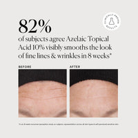 Thumbnail for Naturium Azelaic Topical Acid 10% Jumbo, Face & Skin Care Beauty Treatment with Niacinamide & Vitamin C, 2 oz