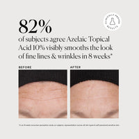 Thumbnail for Naturium Azelaic Topical Acid 10% Jumbo, Face & Skin Care Beauty Treatment with Niacinamide & Vitamin C, 2 oz