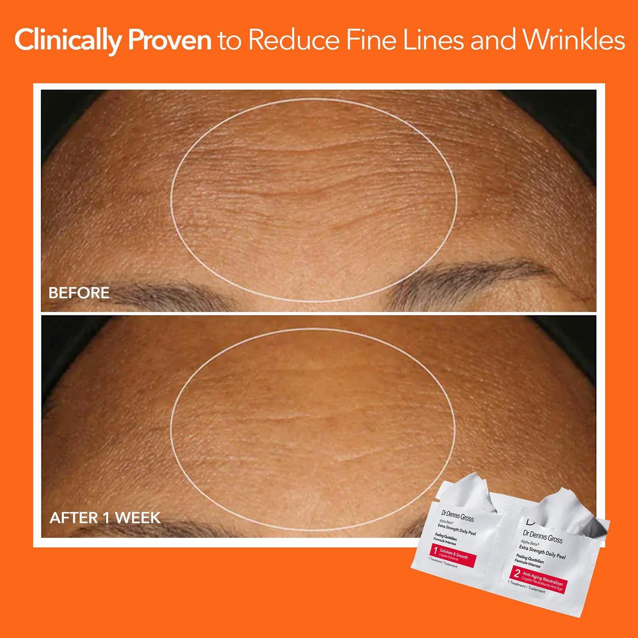 Dr. Dennis Gross Alpha Beta Extra Strength Daily Peel – 2-Step Exfoliating Pads for Enhanced Anti-Aging, Smoother Skin, and Radiant Complexion, 5 Treatments